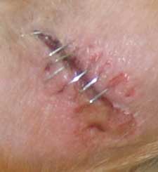 Morgan's wound 10 days ago